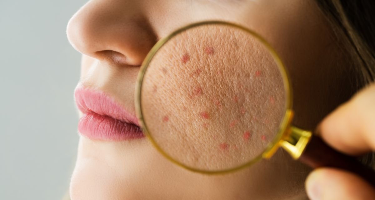 Entendendo a Pele Acneica Por que a Escolha do Sabonete é Crucial